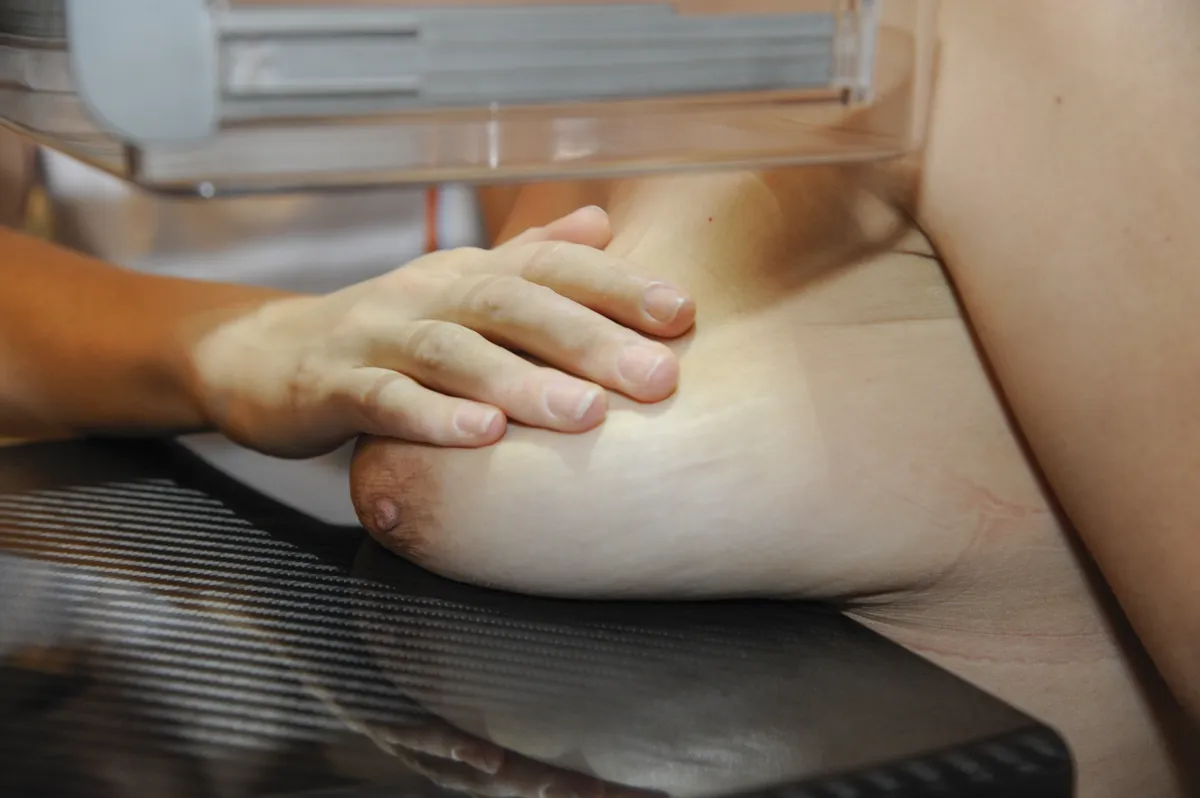 AI Improves Breast Cancer Detection in Trials, Reduces Workload